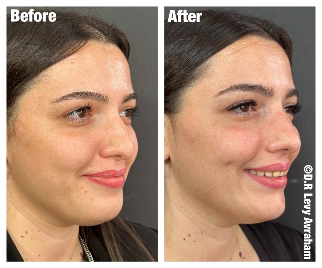 ניתוח גומות חן