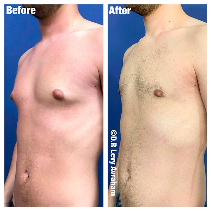 הקטנת חזה לגבר בניתוח גניקומסטיה