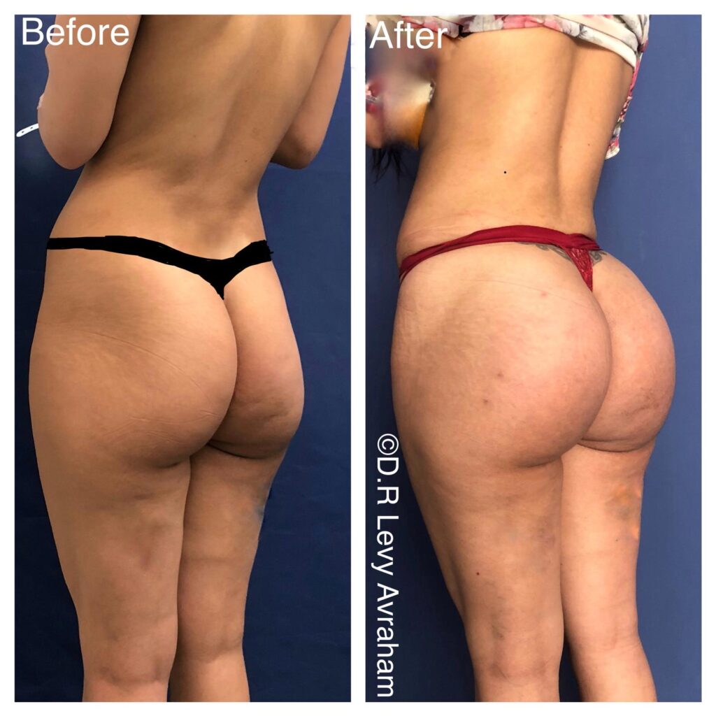 הגדלת ישבן שתלי סיליקון