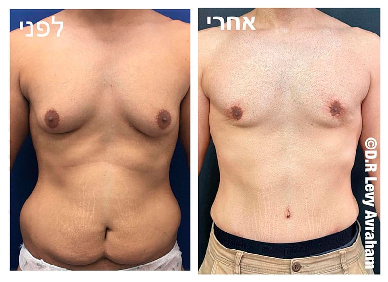 ניתוח גניקומסטיה