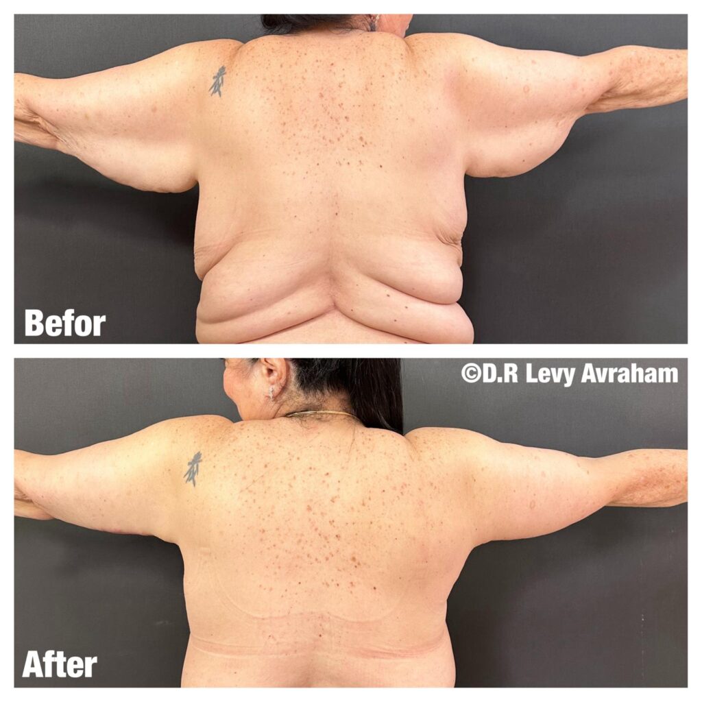 מתיחת זרועות נשים