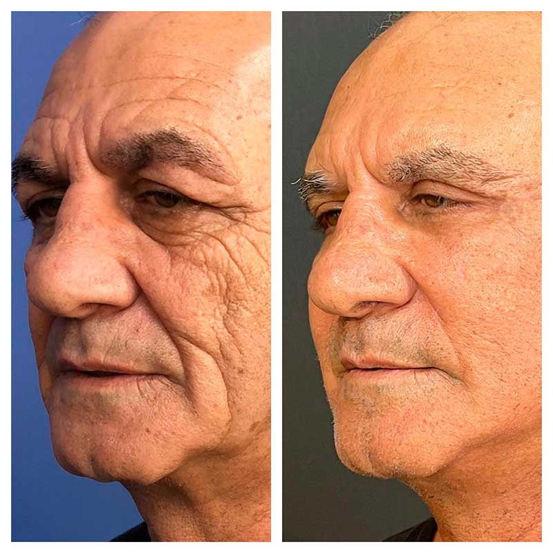 מתיחת פנים לגבר