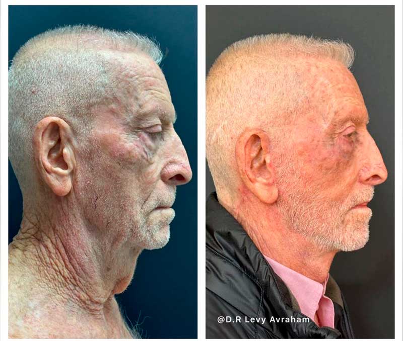 מתיחת פנים לגבר לפני אחרי