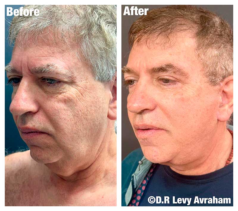 ניתוח מתיחת פנים לגבר