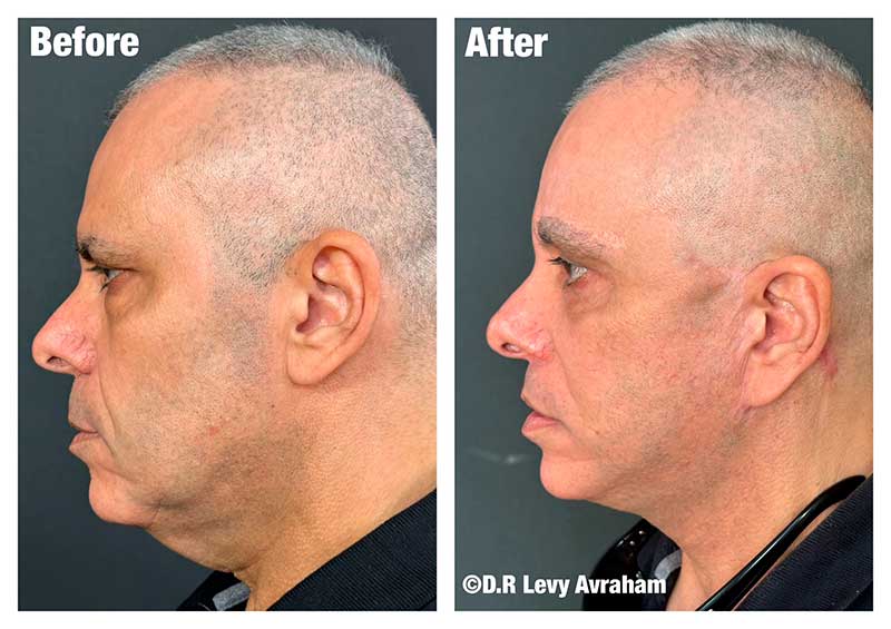 ניתוח מתיחת פנים לגבר