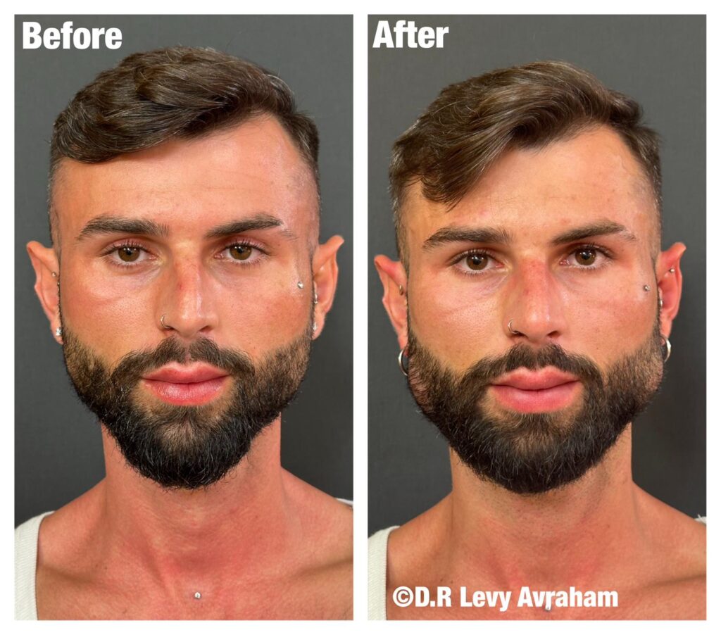 עיצוב קו לסת לגבר