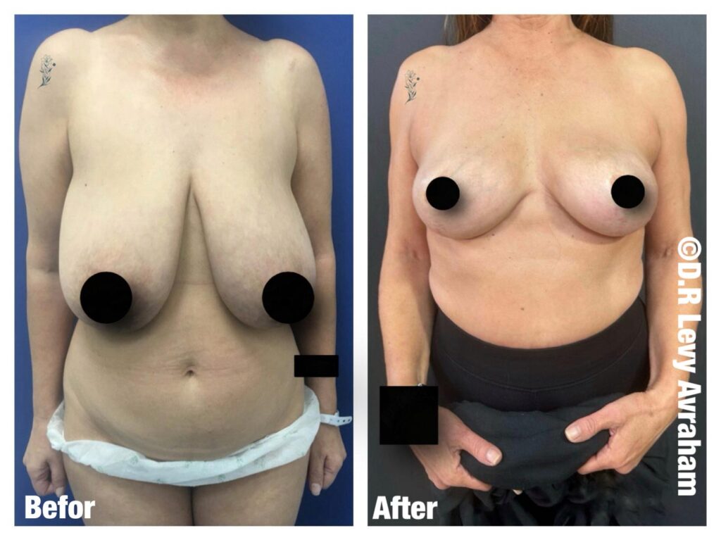 הקטנת חזה תמונה לפני ואחרי