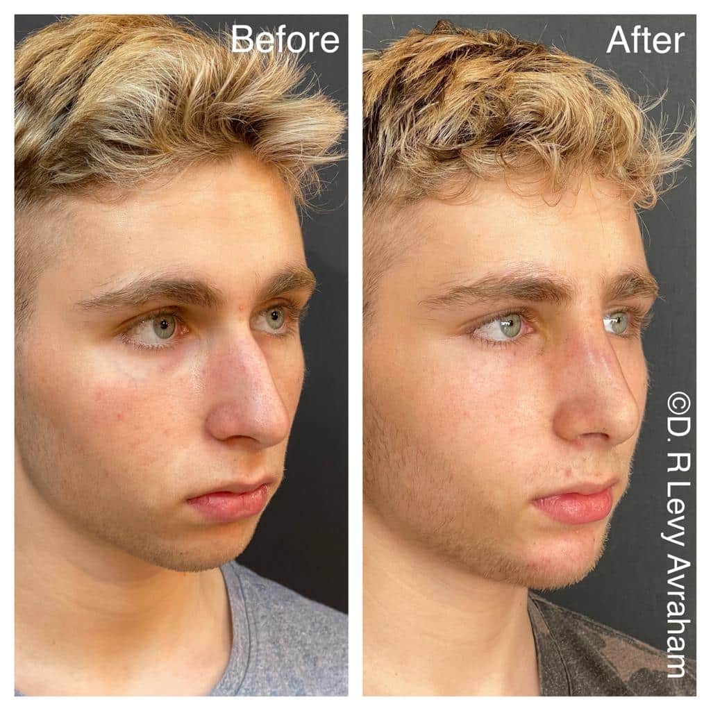 שניתוח אף תמונה לפני ואחרי