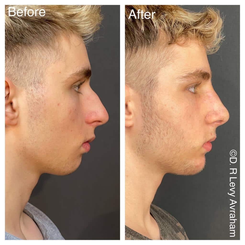 ניתוח אף לפני אחרי