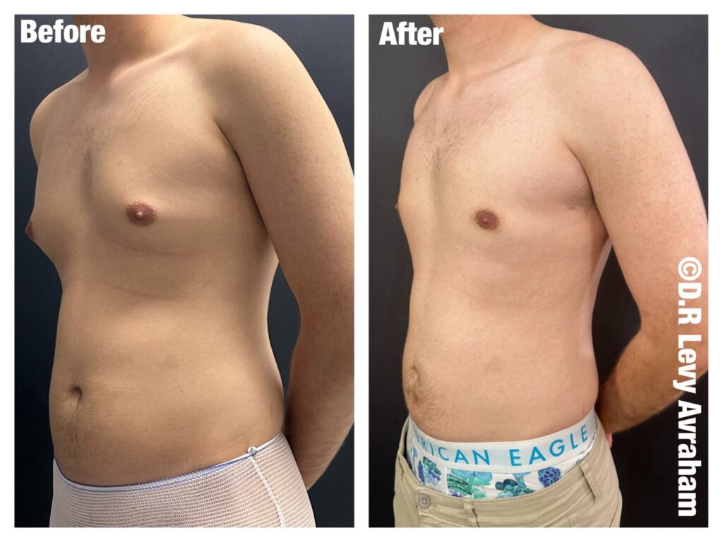 שאיבת שומן בלייזר