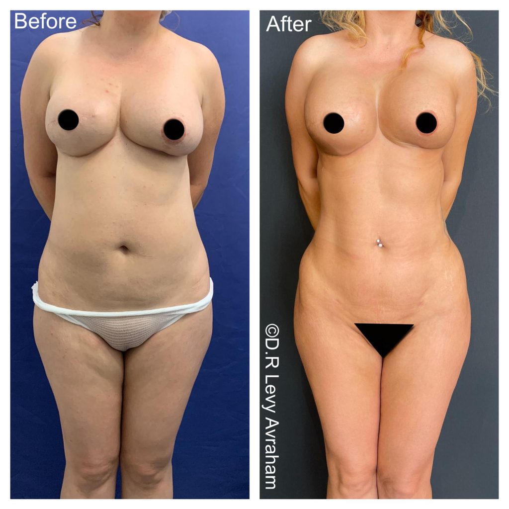 שאיבת שומן ניתוח