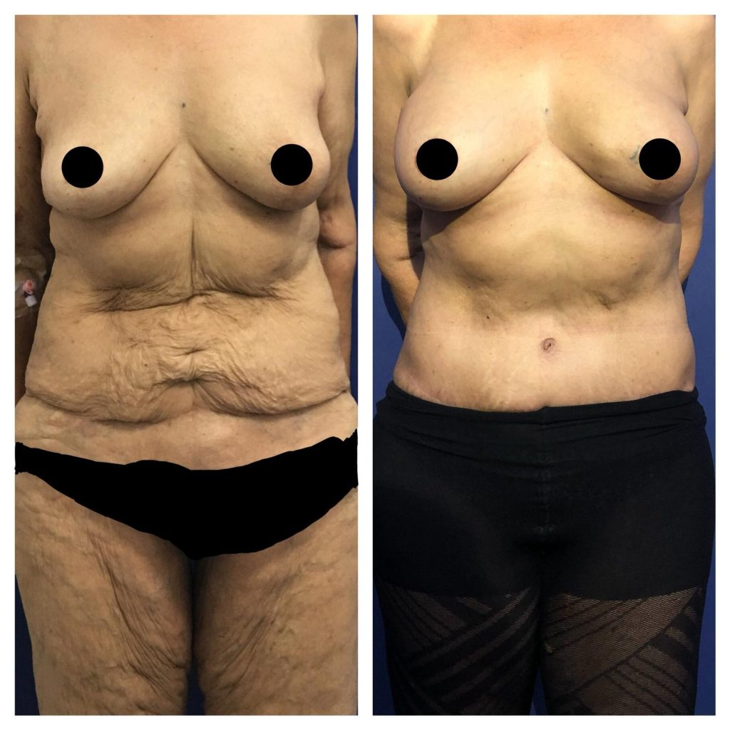 ניתוח מתיחת בטן לפני אחרי