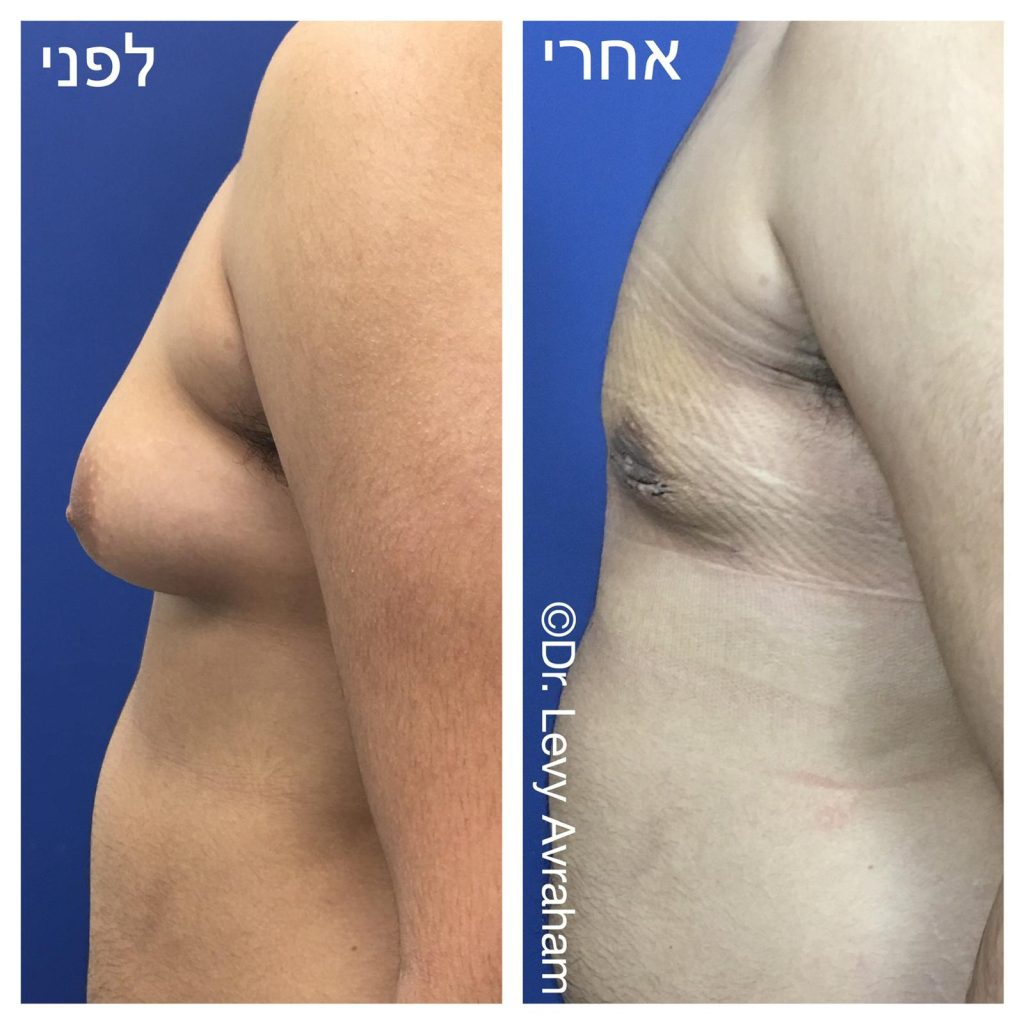 ניתוח גניקומסטיה