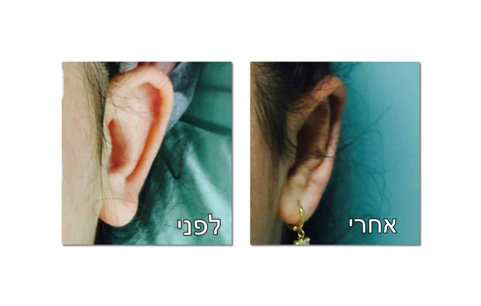 הצמדה של האוזניים לפני ואחרי