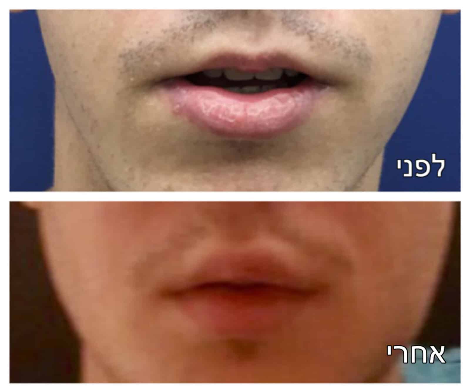 עיבוי שפתיים לפני ואחרי