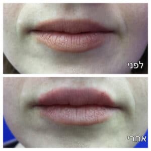 עיבוי שפתיים לפני ואחרי תמונה