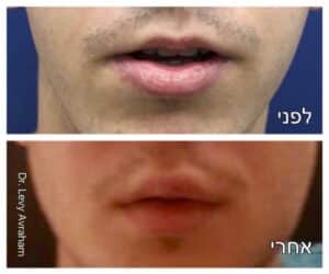 הגדלת שפתיים