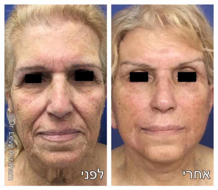 ניתוח מתיחת פנים לפני ואחרי תמונה