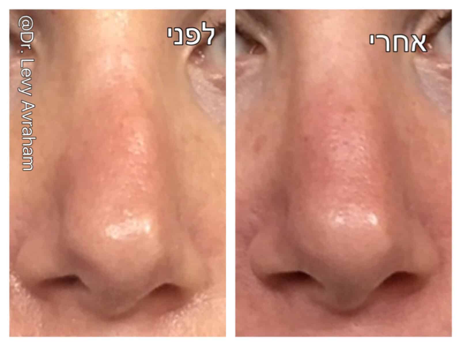 תיקון ניתוח פלסטי באף