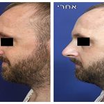 nose-sculpting-450×300