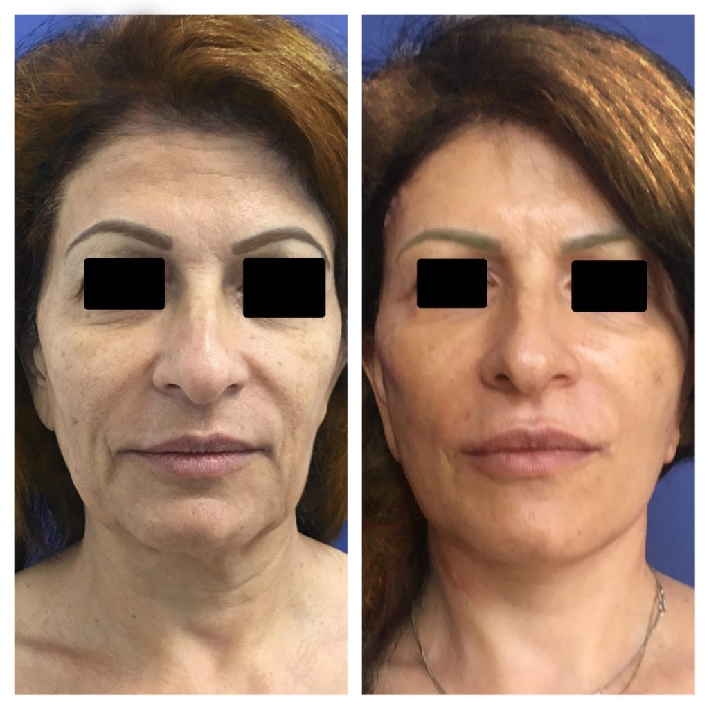 מתיחת פנים שביצע ד