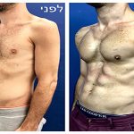 הגדלת חזה לגבר בשתלי סיליקון ועיצוב קוביות