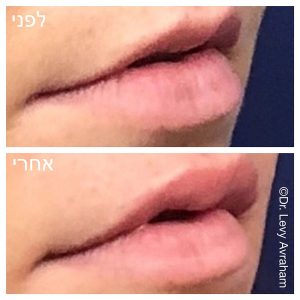 עיבוי שפתיים בחומצה היאלורונית