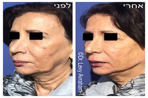 אלנסה חומר מילוי מהפכני