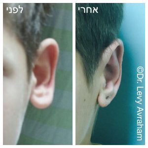 אוזניים בולטות ניתוח