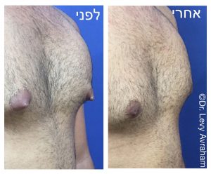 גניקומסטיה ד"ר לוי אברהם