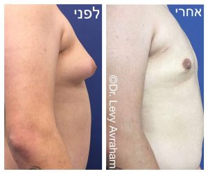 גניקומסטיה ד"ר לוי אברהם