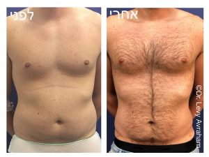 תמונה לפני ואחרי ניתוח הקטנת חזה לגברים