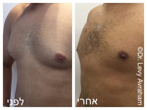 תמונה לפני ואחרי ניתוח הקטנת חזה לגברים