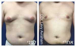 תמונה לפני ואחרי ניתוח הקטנת חזה לגברים