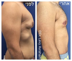 תמונה לפני ואחרי ניתוח הקטנת חזה לגברים