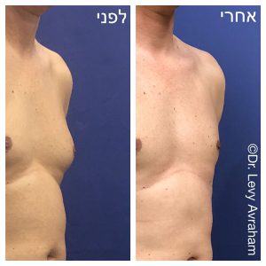 גניקומסטיה ניתוח