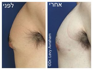 גניקומסטיה ניתוח