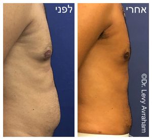 גניקומסטיה ניתוח