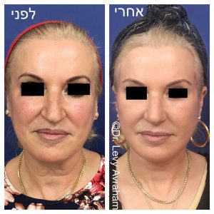 ניתוח עפעפיים תמונה לפני ואחרי