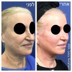 תמונה לפני ואחרי ניתוח אף לאישה לוי אברהם