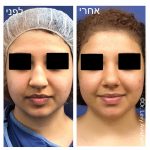 תמונה לפני ואחרי ניתוח אף לאישה