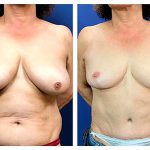 sunken-nipples-surgery-450×300