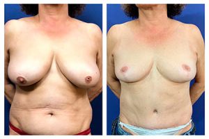 ניתוח לתיקון פטמות שקועות