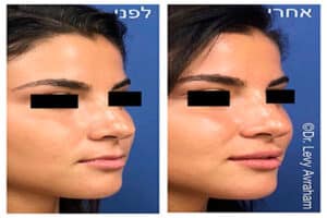 רסטילן Restylane