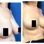 הקטנת שדיים