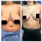 ניתוח להקטנת החזה