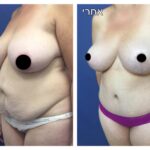 ניתוח מאמי מייקראובר