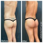 הרמת ישבן ברזילאית