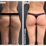 הזרקת שומן לישבן