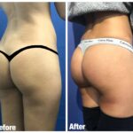 שתלים בישבן